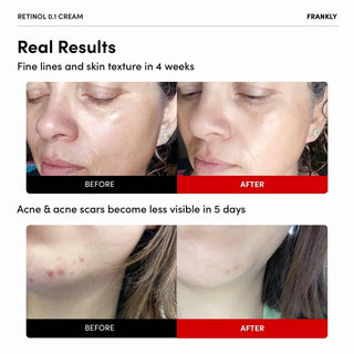 Frankly - Retinol 0.1 Cream 30ml - Koreabe